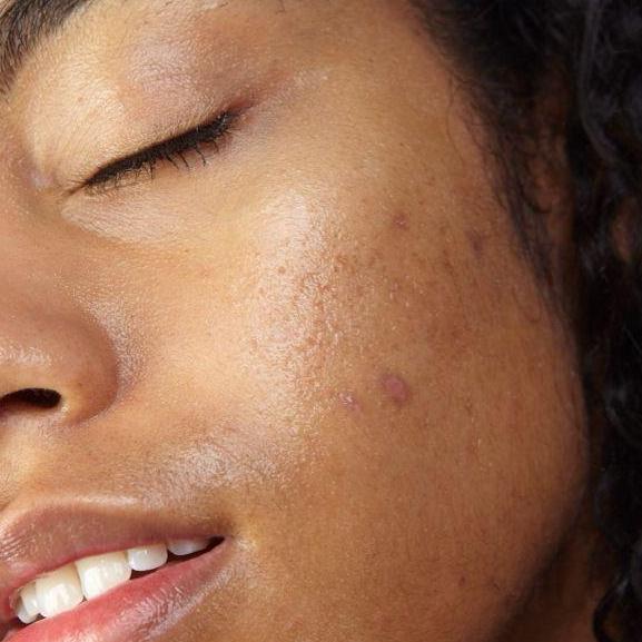 Acne Scar